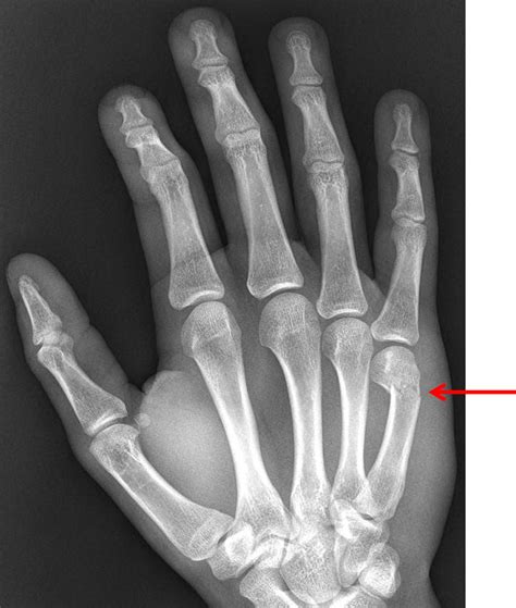 Boxer Fracture Voipatila