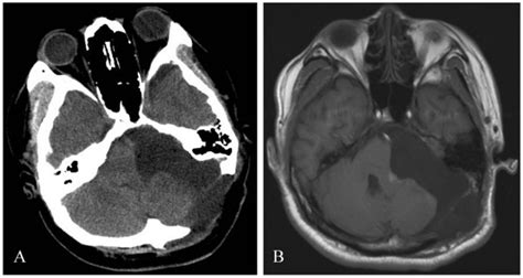 Postoperative Ct A And Mri B Showing Complete Removal Of The Tumor