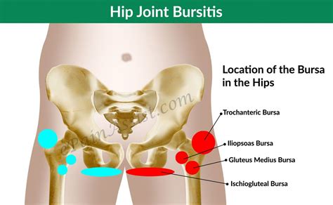 Effective Hip Flexor Stretch: Hip Joint Bursitis & Tendinitis- Causes ...