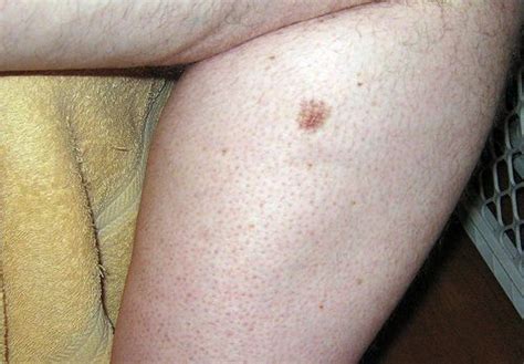 A Close Up Of A Person S Legs With Frecks On The Leg