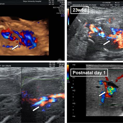 The Fetal Ultrasonography Of Umbilical Vein Varix Uvv In The