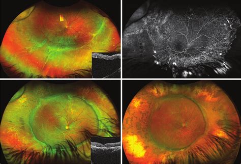 Adult Retinopathy Of Prematurity With Rhegmatogenous Retinal