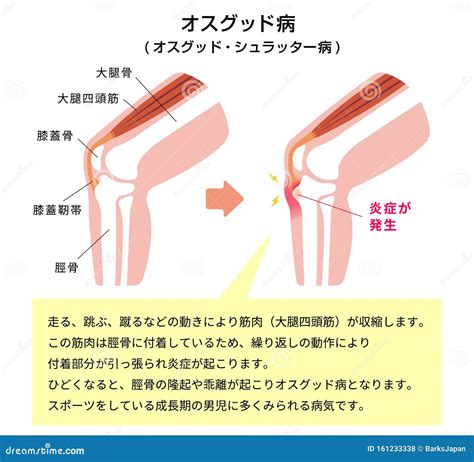 Osgood-schlatter Disease Vector Illustration / Japanese Stock Vector