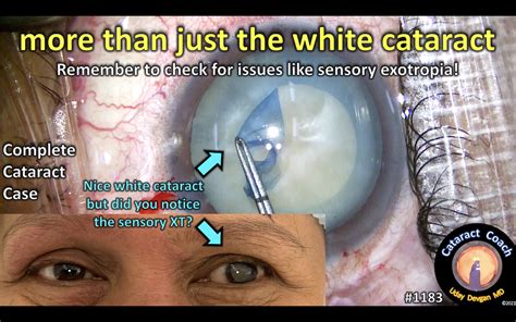 Strabismus Cataract Coach