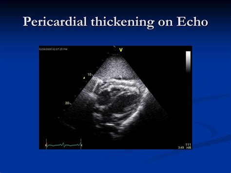 PPT Acute Pericarditis And Pericardial Effusion PowerPoint