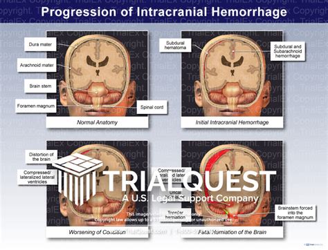 Types Of Intracranial Hemorrhage