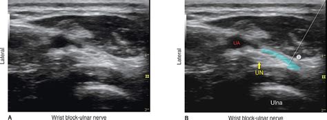 Ultrasound Guided Wrist Block Anesthesia Key
