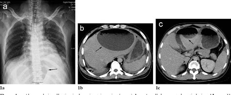 Figure 1 From Penetrating Gastric Ulcer Presenting As A Subcapsular Liver Abscess A Case Report