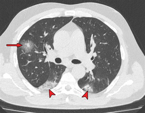 Chest Ct In Covid What The Radiologist Needs To Know Radiographics