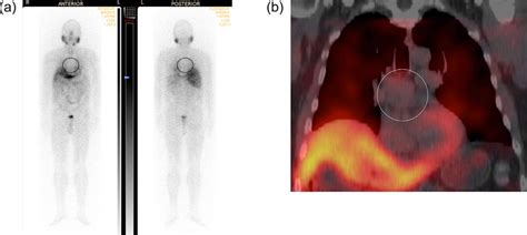 Planar A And Coronal Spect Ct B Images From The I Mibg Scan