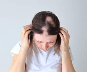 How To Stop Alopecia Areata From Spreading Louise Bell