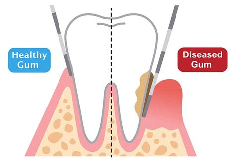 Periodontal Surgerypocket Depth Reduction Periodontal Procedures