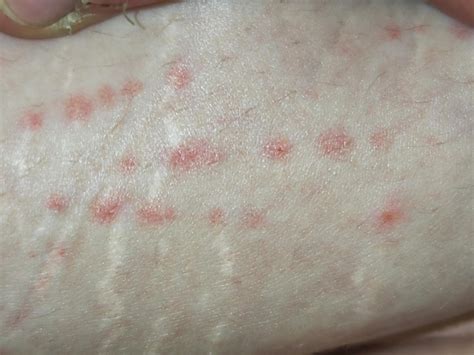 Was für ein Ausschlag könnte das sein? (Gürtelrose, Krätze)