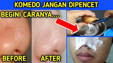 Tips Cara Menghilangkan Komedo Secara Cepat Dengan Putih Telur Pemuda