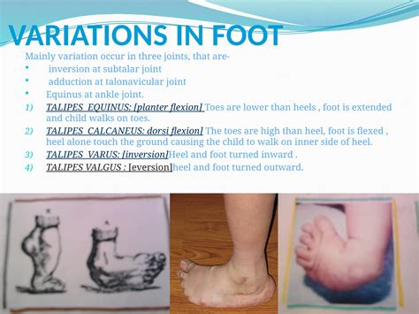 A nice Congenital CLUB FOOT.pptx presentation | PPTX