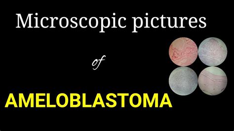 Microscopic Histology Of Ameloblastoma Microscopic Pictures Of Oral