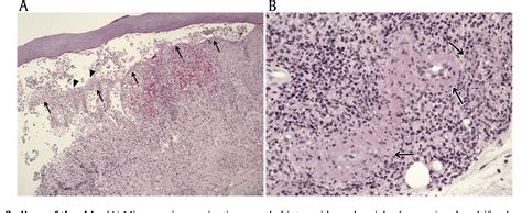 Figure 3 From Warfarin Skin Necrosis Mimicking Calciphylaxis In A Patient With Secondary