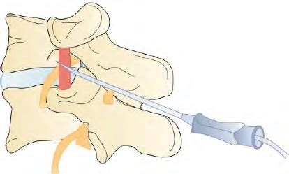 Once the intertransverse ligament is perforated, the catheter is... | Download Scientific Diagram