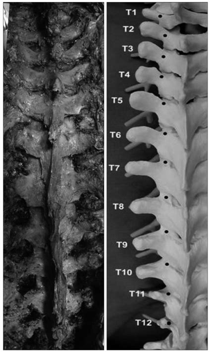 Free Hand Pedicle Screw Placement In The Thoracic Spine Without Any