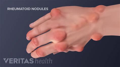 Therapy For Rheumatoid Arthritis In The Hand 60 Off