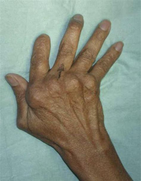 Muscle Hypoxia In Rheumatoid Hands Does It Play A Role In Ulnar Drift Journal Of Hand Surgery