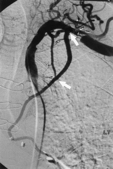 Extrathoracic Subclavian Internal Thoracic Artery Bypass Grafting The Annals Of Thoracic Surgery