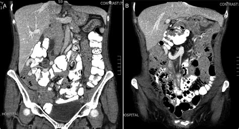 Subhepatic Caecal Tumour In An Adult With Intestinal Malrotation Bmj Case Reports