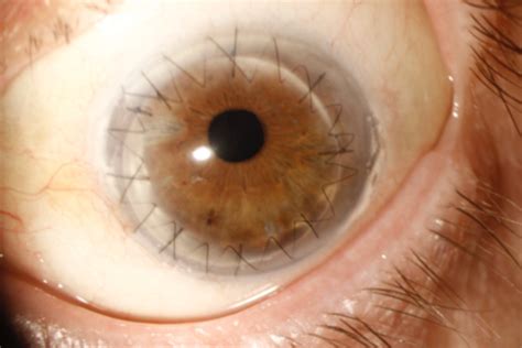 Post Corneal Transplant — Qei Laser · Laser Eye Surgery · Queensland