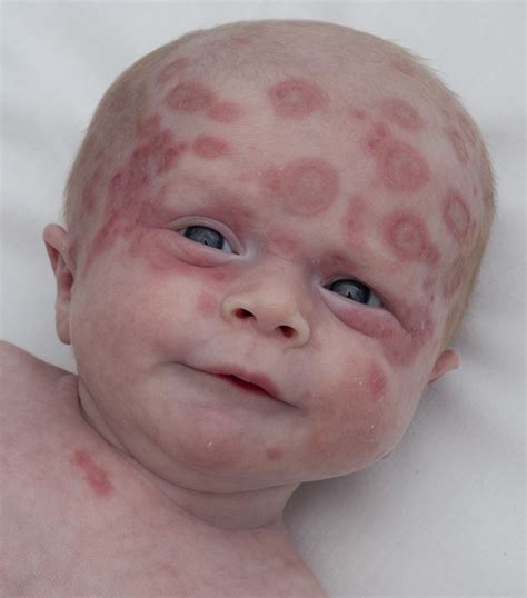 Benign Neonatal Rashes