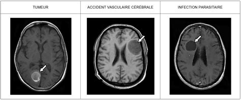 FICHES DIDENTIFICATION DE LÉSIONS CÉRÉBRALES OU MÉDULLAIRES Site des