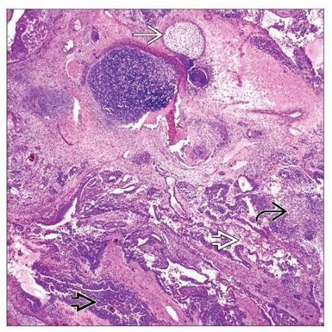 Germ Cell Tumors Types