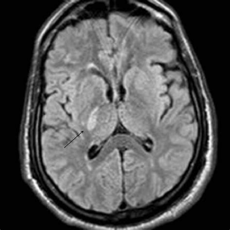 MRI brain during first stroke, three years back showing FLAIR ...