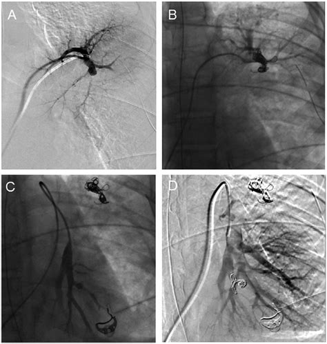 Selective Embolization Digital Subtraction Angiography Confirmed 2