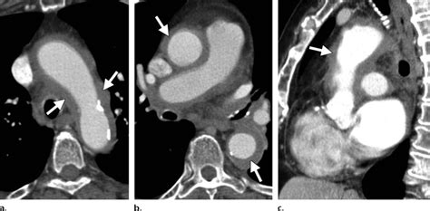 Axial Ct Scans At The Level Of The Aortic Arch A And Right Pulmonary