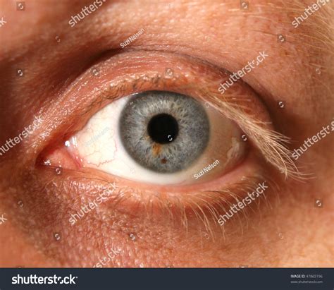 Close Eye Birthmark Stock Photo 47865196 - Shutterstock