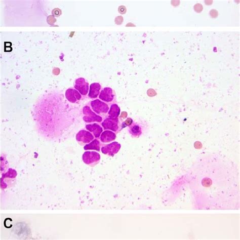 Pdf Cerebrospinal Fluid Cytology In A Cohort Of Pediatric Patients With Metastatic Medulloblastoma