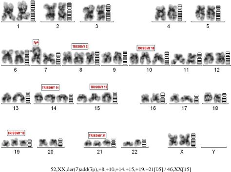 figure   cytogenetics  fish studies  multiple myeloma
