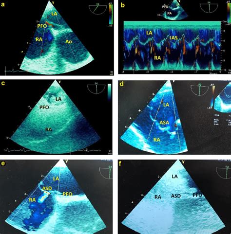 Representative Images Of Pfo 2 D Tee Views A Pfo With Left To Right