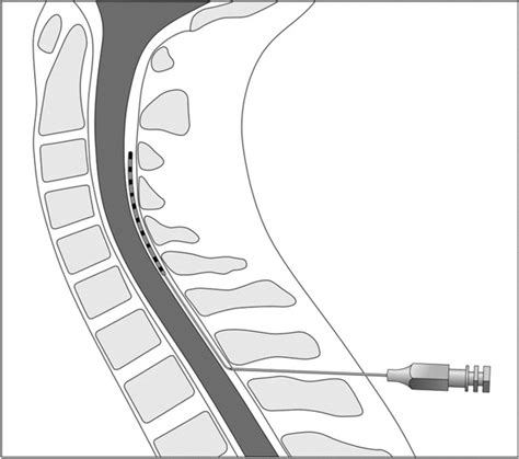 Schematic Drawing Illustrating Percutaneous Insertion Of The Spinal Download Scientific Diagram