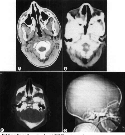 Figure 2 From Anatomic Findings And Management Of Choanal Atresia And The Charge Association