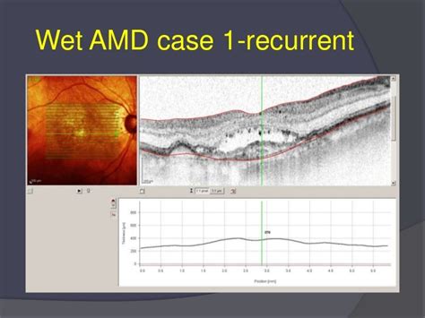 How 3 d oct enhances amd & dme treatment