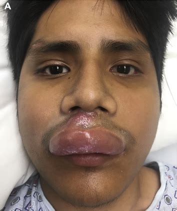 Staph Infection Lips Contagious Lipstutorial Org