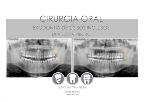 Sisos Inclusos Cirurgia Oral Clinica Dentaria Oral