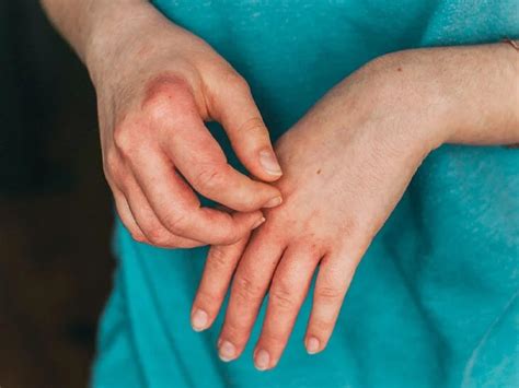 Skin Peeling On One Finger Flaky Skin Symptoms Causes Treatments