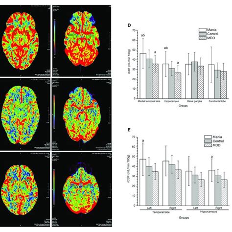 Comparisons Of Regional Cerebral Blood Flow Among The Mania