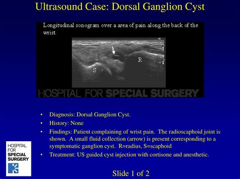 Ganglion Cyst Wrist Ultrasound