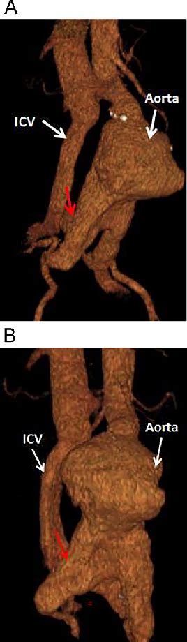 Figure From Spontaneous Ilio Iliac Arteriovenous Fistula A Rare