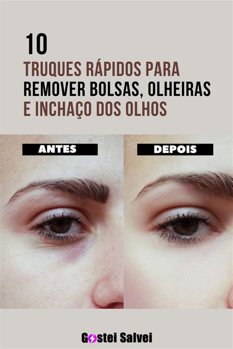 10 Truques rápidos para remover bolsas olheiras e inchaço dos olhos