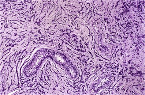 Sex Cord Stromal Tumors Of The Testis Diagnostic Histopathology