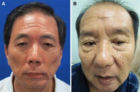 Postoperative Appearance At 2 Months A Post Endoscopic Excision